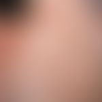 Lupus miliaris disseminatus faciei. pinhead - to lenticular, reddish-brownish, sometimes excoriat...