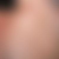Lupus miliaris disseminatus faciei. pinhead - to lenticular, reddish-brownish, sometimes excoriat...