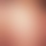 Lupus miliaris disseminatus faciei, brownish-red, partly excised papules of the cheek and periorb...