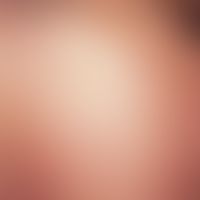 Lupus miliaris disseminatus faciei, brownish-red, partly excised papules of the cheek and periorb...