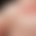 Zoster: disseminierte, gruppierte Bläschen und Pusteln auf geröteter Haut bei einem 38-jährigen M...