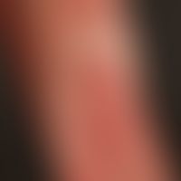 Zoster:&nbsp;ausgeprägter Zoster bei einem 53-jährigen Patienten. Disseminierte, gruppierte Bläsc...