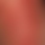 Zoster. Detailvergrößerung: Disseminierte und gruppierte Bläschen und Pusteln auf düsterroten Ery...