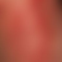 Zoster. Detailvergrößerung: Disseminierte und gruppierte Bläschen und Pusteln auf düsterroten Ery...