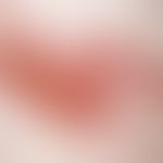 Zoster. Seit 6 Tagen persistierende, segmental angeordnete Erosionen, z.T. krustös belegt, am Rüc...