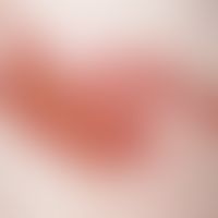Zoster. Seit 6 Tagen persistierende, segmental angeordnete Erosionen, z.T. krustös belegt, am Rüc...