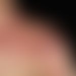 Zoster: Seit 6 Tagen bestehende, ausgedehnte, teils herpetiform angeordnete, sich hämorrhagisch-n...