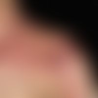 Zoster: Seit 6 Tagen bestehende, ausgedehnte, teils herpetiform angeordnete, sich hämorrhagisch-n...