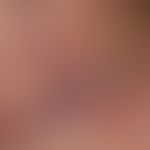 Zoster: Detailvergrößerung: Ausgedehnte, teils herpetiform gruppierte, sich hämorrhagisch-nekroti...