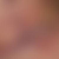 Zoster: Detailvergrößerung: Ausgedehnte, teils herpetiform gruppierte, sich hämorrhagisch-nekroti...