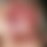 Zoster im Trigeminusbereich. Bei der 80-jährigen Patientin ist es nach anfänglichen einseitigen C...