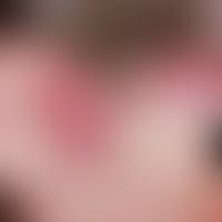 Zylindrom. 72 Jahre alte Patientin mit familiären, multiplen Zylindromen (Brooke-Spiegler-Syndrom...