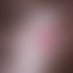 Cylindrome: Roughly elastic, hairless tumours with a reflective surface, interspersed with telang...