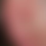 Cylindrome: Solitary, chronically active, approx. 0.8 cm high, smooth, red node localized at the ...