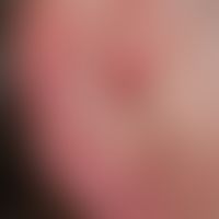 Cylindrome: Solitary, chronically active, approx. 0.8 cm high, smooth, red node localized at the ...