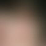 Multiple, 0.5-2.0 cm large, skin-coloured or light red, bulging, protuberant papules and nodules ...