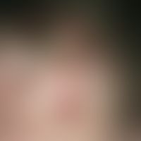 Multiple, 0.5-2.0 cm large, skin-coloured or light red, bulging, protuberant papules and nodules ...