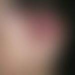 Cylindrome. multiple, chronically stationary (tumor problem since adolescence), disseminated (als...
