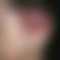 Cylindrome. multiple, chronically stationary (tumor problem since adolescence), disseminated (als...