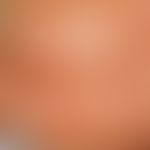 Staphylococcal Scalded Skin Syndrome. Flächiges Erythem, subkorneale Blasen mit groblamellöser Ab...