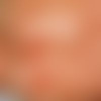 Staphylococcal Scalded Skin Syndrome. Flächiges Erythem, subkorneale Blasen mit groblamellöser Ab...