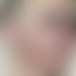 Leukemia, chronic lymphatic of the skin of the B-cell type. For several months increasing, soft, ...