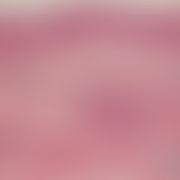 Lymphangiosis carcinomatosa. Schüttere, fleckförmige perivaskulär angeordnete lymphozytäre Infilt...