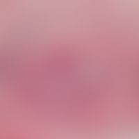 Lymphangiosis carcinomatosa. Detailvergrößerung: Histologisches Korrelat eines Erysipelas carcino...