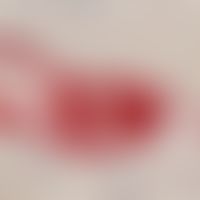 Lymphangiosis carcinomatosa. Detailvergrößerung: Immunhistologische Aufarbeitung mit Antikörpern ...