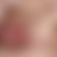 Lymphangiosis carcinomatosa. Z.n. inkomplett reseziertem Mamma-Ca. Seit etwa 2 Jahren bestehender...