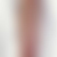Lymphangitis acuta. red, pressure-painful, palpable strand on the right forearm in the course of ...