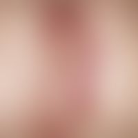 Lymphocytic infiltration of the skin, usually several, often symmetrically localized, initially s...