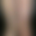 Lymphedema: one-sided, skin-coloured swelling due to insufficient transport capacity of the lymph...