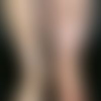Lymphedema: one-sided, skin-coloured swelling due to insufficient transport capacity of the lymph...