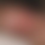 Lymphogranuloma inguinale: Greasy ulcer in the area of the coronal furrow in a 26-year-old man, 1...