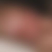 Lymphogranuloma inguinale: Greasy ulcer in the area of the coronal furrow in a 26-year-old man, 1...