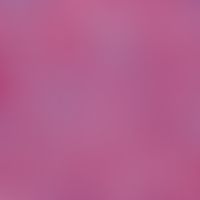 Lymphom, kutanes. Immunhistologische Aufarbeitung von kutanen Infiltraten eines B-Zell-Lymphoms. ...