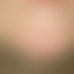 Lymphoma, cutaneous T-cell lymphoma; condition of the previously g. patient 6 months after radiot...