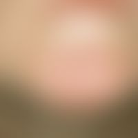 Lymphoma, cutaneous T-cell lymphoma; condition of the previously g. patient 6 months after radiot...