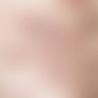 Lymphom, kutanes T-Zell-Lymphom. Typ Mycosis fungoides, mehrjähriges&nbsp; Plaquestadium, Transfo...