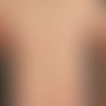 Lymphoma, cutaneous T-cell lymphoma, type Mycosis fungoides, generalized plaque stage; started 10...