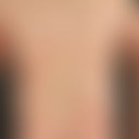 Lymphom, kutanes T-Zell-Lymphom. Typ Mycosis fungoides, generalisiertes Plaquestadium; Beginn vor...