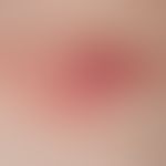 Lymphoma, cutaneous T-cell lymphoma. 2 years old, solitary, chronically stationary, on the back l...
