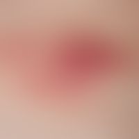 Lymphoma, cutaneous T-cell lymphoma. 2 years old, solitary, chronically stationary, on the back l...