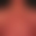 Sézary syndrome: erythroderma with varying degrees of skin colouring and "thickening" and general...