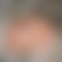 Primär kutanes B-Zell-Lymphom:&nbsp;rasch wachsender, großflächiger, bräunlich-rötlicher, schmerz...