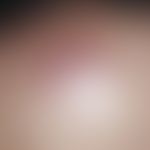 Primär kutanes B-Zell-Lymphom:&nbsp;Seit 8 Monaten langsam wachsender, livid-roter, flacher, derb...