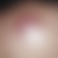 Primär kutanes B-Zell-Lymphom:&nbsp;Seit 8 Monaten langsam wachsender, livid-roter, flacher, derb...