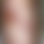 Primär kutanes B-Zell-Lymphom: multiple, seit 3 Monaten verstärkt wachsende, chronisch dynamische...