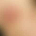 Primary cutaneous follicular center lymphoma: coarse, painless, solid tumor, clearly elevated abo...